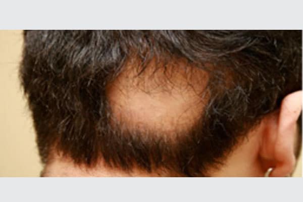 Alopecia Areata - Dr. Kamil Al Rustom Skin & Laser Centre