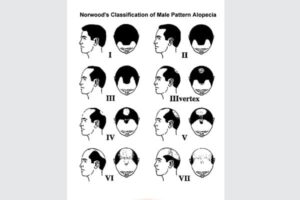 alopecia ae