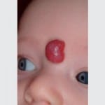 hemangioma