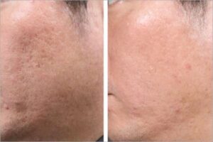 laser for acne scars