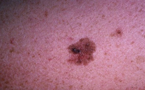 Рак кожи — Википедия