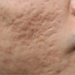 men acne scars