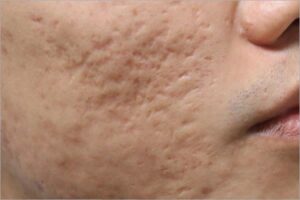 men acne scars
