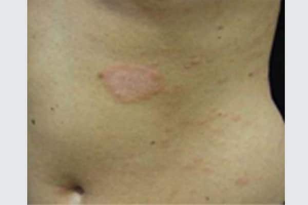 Pityriasis Rosea - Dr. Kamil Al Rustom Skin & Laser Centre