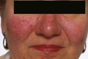 Rosacea