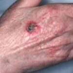 squamous cell carcinoma | Skin Cancer