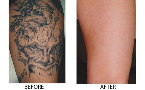 Tattoo Removal Laser - Dr. Al Rustom Skin & Laser Centre
