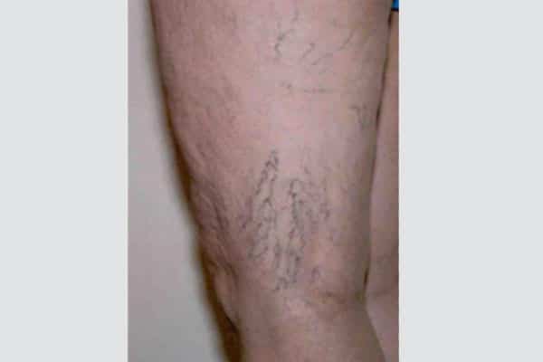 What Causes Spider Veins on Your Legs  Reno Sparks Medspa