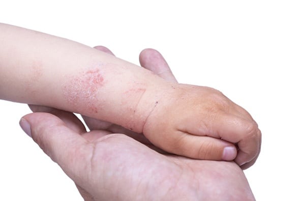 Eczema and Your Skin
