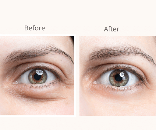 Under eye Fillers2 Under eye Fillers2