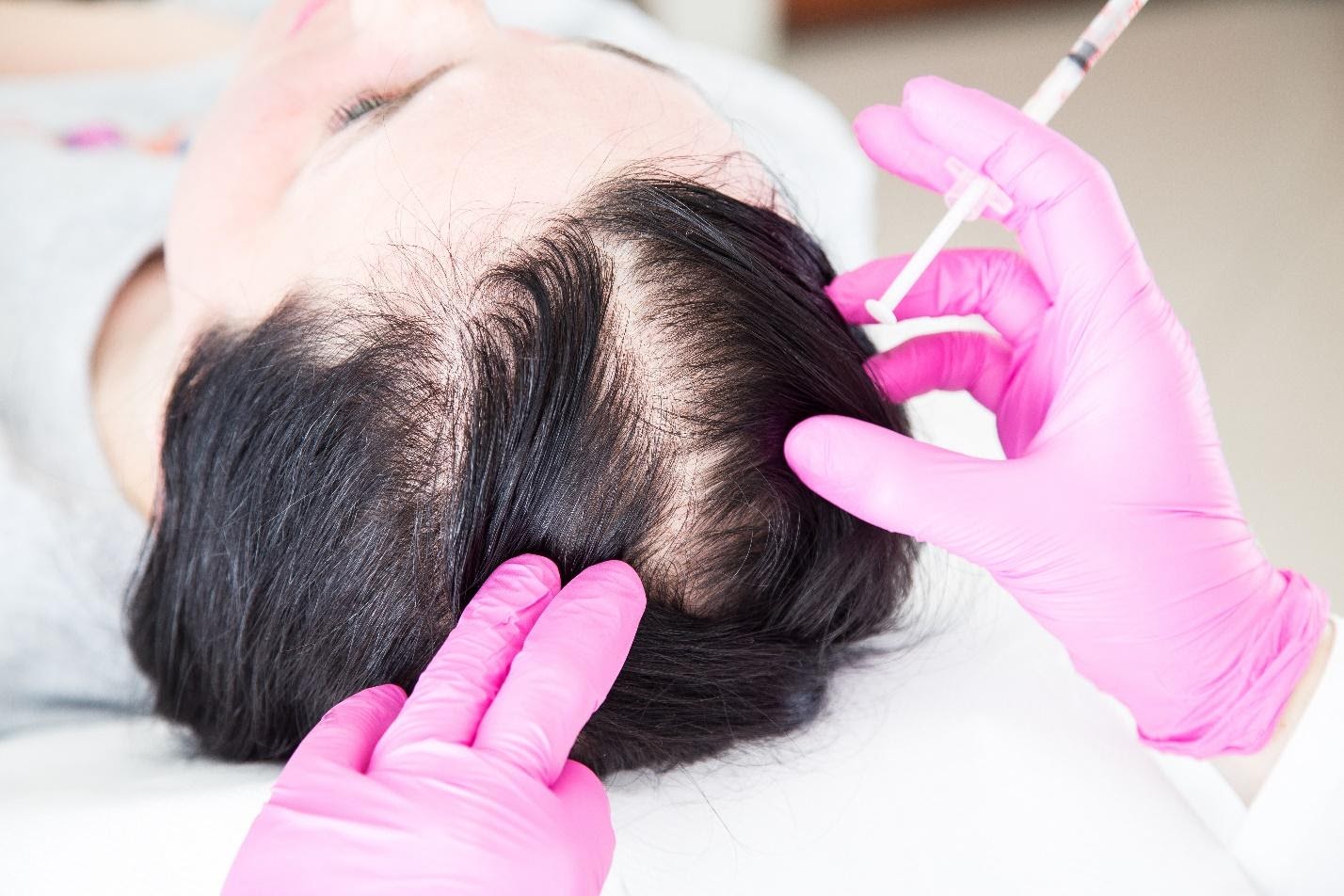 Hair Loss - Dr. Kamil Al Rustom Skin & Laser Centre