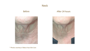 image of skin improvement with skin booster